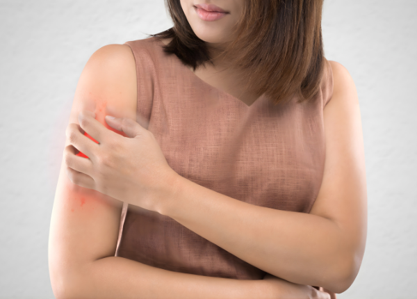 Des années d'eczéma infernal